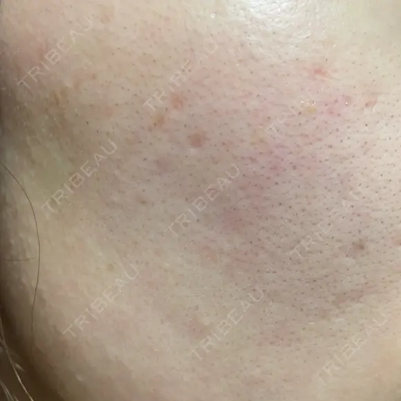 ルメッカ / LDM・インテンスウルトラ Chloe Cheongdam Clinic （クロエチョンダムクリニック） DAY 5 メイン用