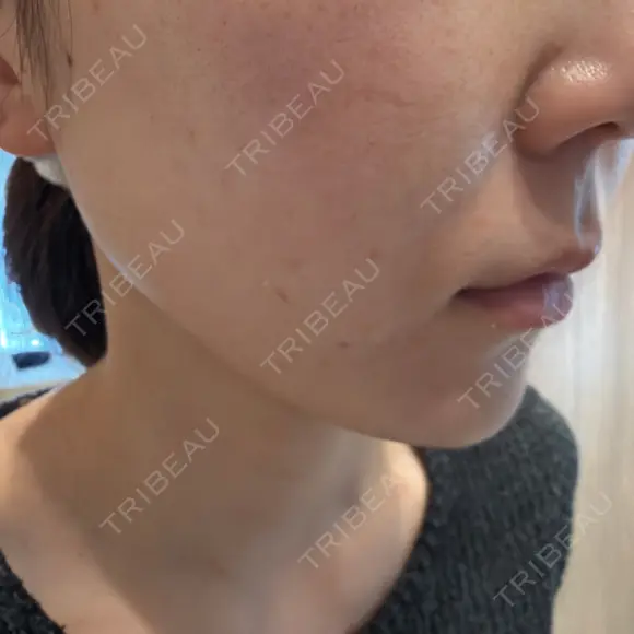 ルメッカ ルラ美容クリニック 札幌本院 AFTER メイン用
