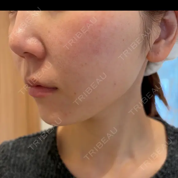 ルメッカ ルラ美容クリニック 札幌本院 DAY 6 メイン用