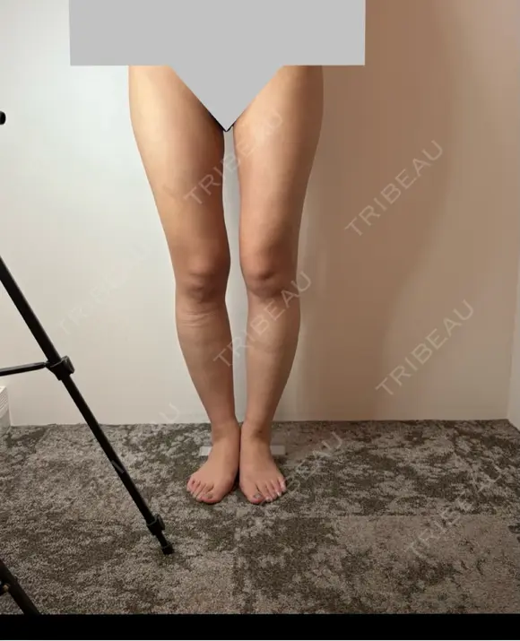脂肪吸引（脚） GAYA body design clinic AFTER メイン用