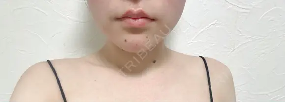 ボトックス（エラ・小顔） / ボトックス（肩） アリエル美容クリニック 水戸院 DAY 26 メイン用