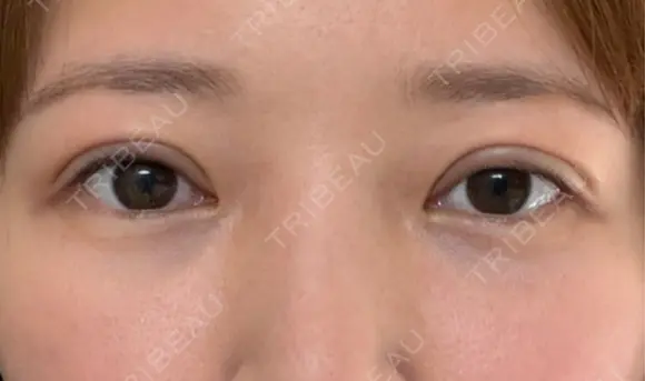 眼瞼下垂（切開） / 下まぶたたるみ取り WOM CLINIC GINZA （ワム クリニック ギンザ） DAY 14 メイン用
