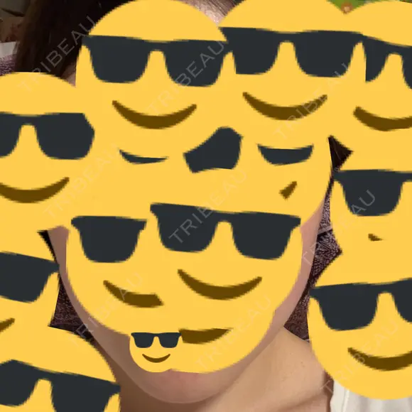 ボトックス（エラ・小顔） Natural Skin Clinic 自由ヶ丘院 AFTER メイン用