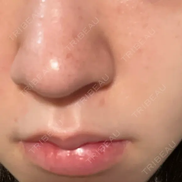 ピーリング（ニキビ・毛穴） / 光治療（フォトフェイシャルなど） / ピーリング（ハリ・ツヤ） DAILY SKIN CLINIC 新宿院 AFTER メイン用