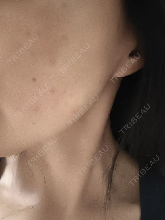 ルメッカ ルラ美容クリニック 新潟院 DAY 0 メイン用