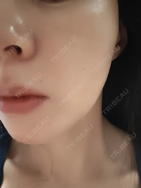 ルメッカ ルラ美容クリニック 新潟院 AFTER メイン用
