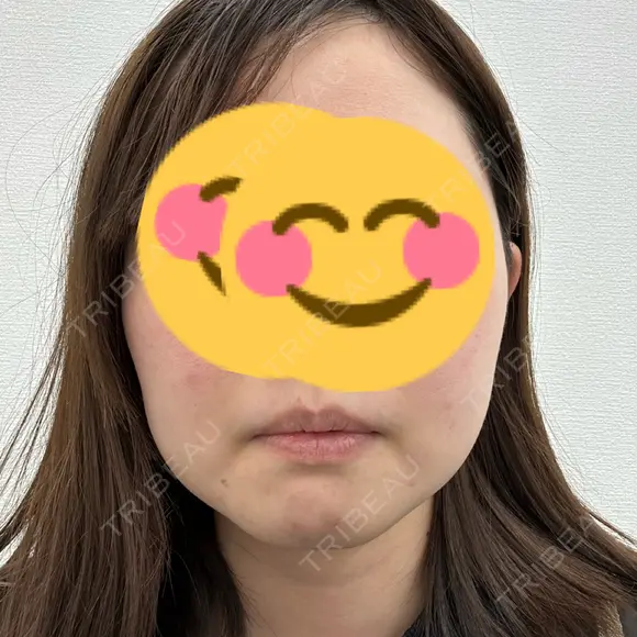 ボトックス（あご） / ボトックス（エラ・小顔） / ボトックス（口角） / RF（高周波）たるみ治療 ベールクリニック DAY 1 メイン用