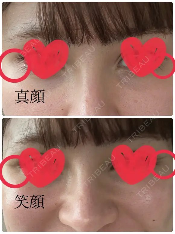 ボトックス（あご） / 脂肪溶解注射（顔） / ボトックス（目尻） TCB東京中央美容外科 高崎院 DAY 13 メイン用