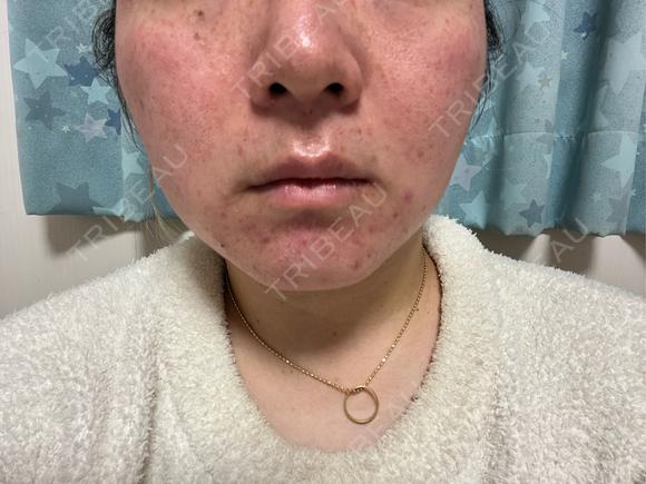 ポテンツァ ルラ美容クリニック 岐阜院 DAY 0 メイン用