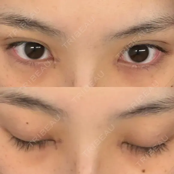 二重埋没 / 目頭切開 / 上まぶたの脂肪取り アリエル美容クリニック 郡山院 DAY 35 メイン用