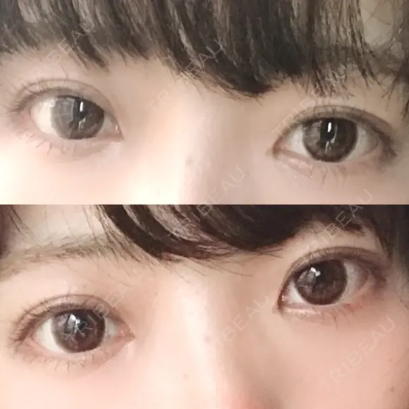 二重埋没 / 上まぶたの脂肪取り 東京ヒルズクリニック 新宿院 DAY 60 メイン用