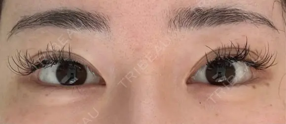 目頭切開 / 目尻切開 / タレ目形成・グラマラスライン（切開） EMMA CLINIC（エマクリニック） AFTER メイン用