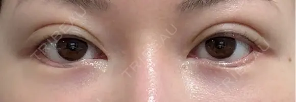 二重埋没 / 目尻切開 / タレ目形成・グラマラスライン（切開） / 自然癒着法 Stand by Beauty Clinic DAY 18 メイン用