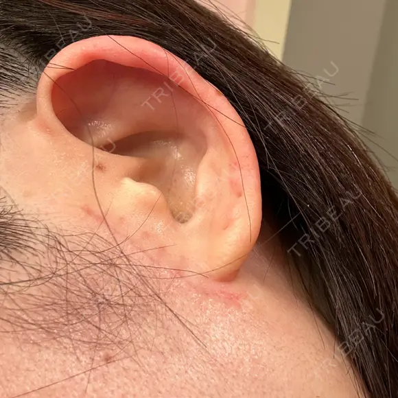 切開リフト GRACY TOKYO CLINIC【グレイシートウキョウクリニック】 DAY 31 メイン用
