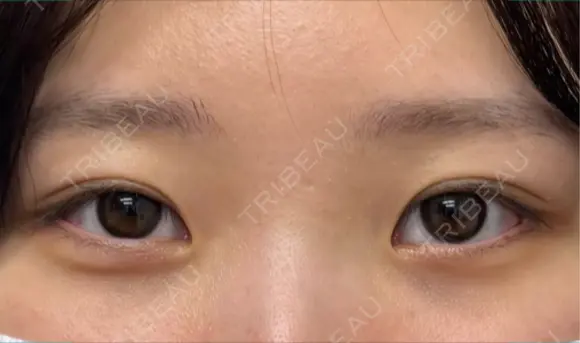 クマ治療 ネビュラクリニック 京都院 AFTER メイン用
