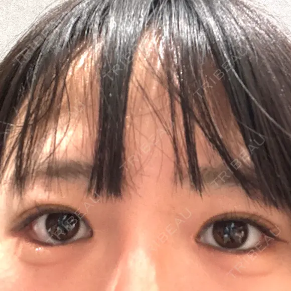 二重埋没 / 目頭切開 / 目尻切開 / タレ目形成・グラマラスライン（切開） ziz CLINIC AFTER メイン用