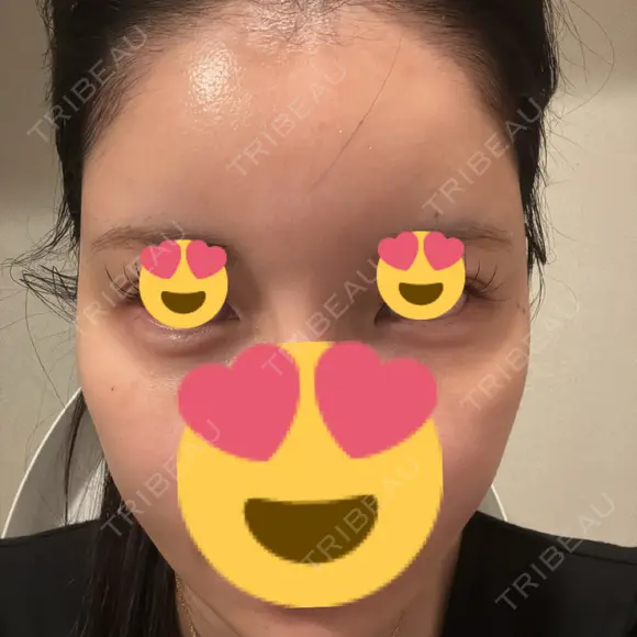 ヒアルロン酸注入（涙袋） / ヒアルロン酸注入（頬） / ヒアルロン酸注入（こめかみ） PRISM Beauty Clinic 新宿院 DAY 1 メイン用