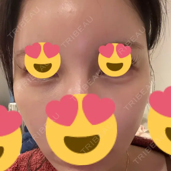 ヒアルロン酸注入（涙袋） / ヒアルロン酸注入（頬） / ヒアルロン酸注入（こめかみ） PRISM Beauty Clinic 新宿院 DAY 2 メイン用