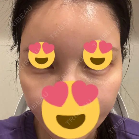 ヒアルロン酸注入（涙袋） / ヒアルロン酸注入（頬） / ヒアルロン酸注入（こめかみ） PRISM Beauty Clinic 新宿院 AFTER メイン用