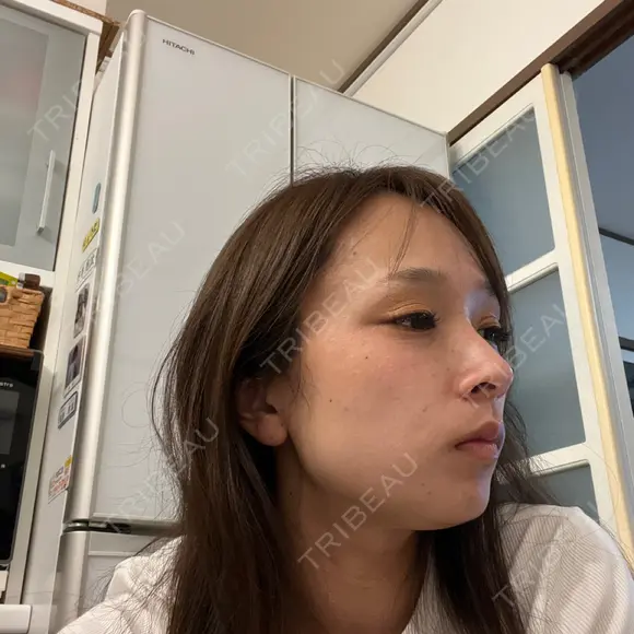 ボトックス（エラ・小顔） / ボトックス（目尻） / ボトックス（額） ルラ美容クリニック 名古屋栄院 / ルラスキンクリニック 名古屋栄院 DAY 0 メイン用
