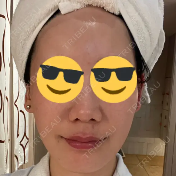 肌育注射（ジュベルックなど） メディアージュクリニック 大阪梅田院 AFTER メイン用