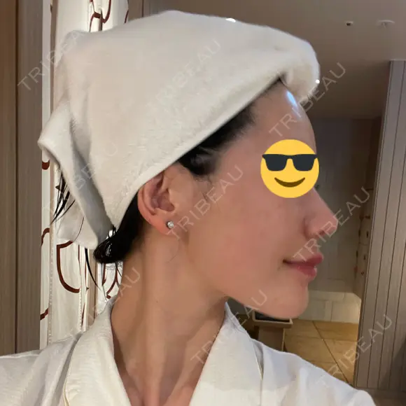 肌育注射（ジュベルックなど） メディアージュクリニック 大阪梅田院 DAY 9 メイン用