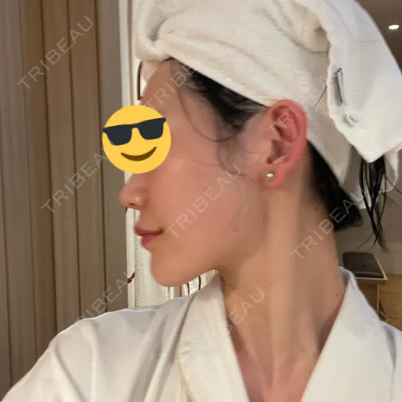 肌育注射（ジュベルックなど） メディアージュクリニック 大阪梅田院 DAY 9 メイン用