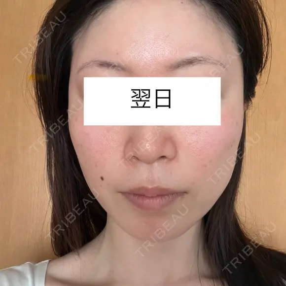 白玉点滴・注射 / ピコレーザートーニング（美白・肝斑） ライズワン美容皮膚科クリニック DAY 1 メイン用