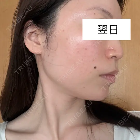 白玉点滴・注射 / ピコレーザートーニング（美白・肝斑） ライズワン美容皮膚科クリニック DAY 1 メイン用