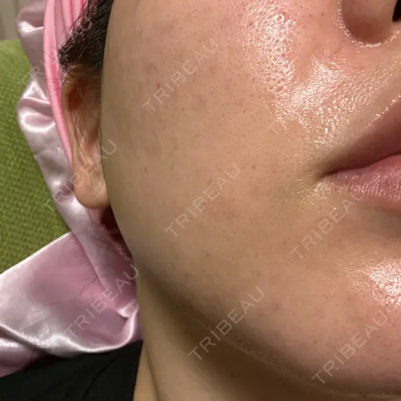 肌育注射（ジュベルックなど） Natural Skin Clinic 自由ヶ丘院 AFTER メイン用