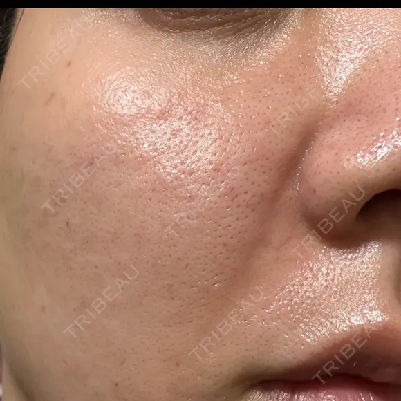 肌育注射（ジュベルックなど） Natural Skin Clinic 自由ヶ丘院 DAY 0 メイン用