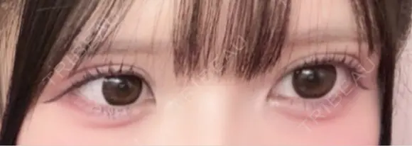 二重埋没 / ヒアルロン酸注入（涙袋） アリエル美容クリニック 大宮院 DAY 21 メイン用