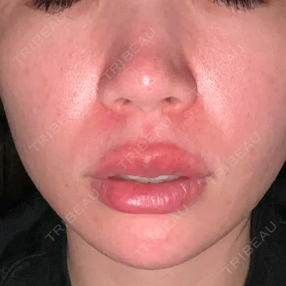 美肌レーザー / レーザーフェイシャル / 赤み除去レーザー AI Beauty Clinic （エーアイ美容クリニック） AFTER メイン用