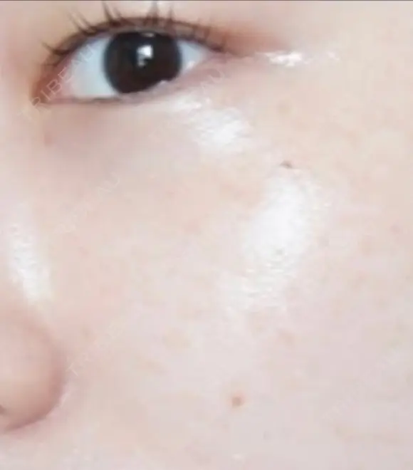 ピコレーザートーニング（美白・肝斑） / フラクショナルレーザー（毛穴・ニキビ跡） ルラ美容クリニック 渋谷本院 AFTER メイン用