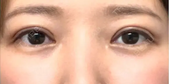 眼瞼下垂（切開） / 下まぶたたるみ取り WOM CLINIC GINZA （ワム クリニック ギンザ） DAY 21 メイン用