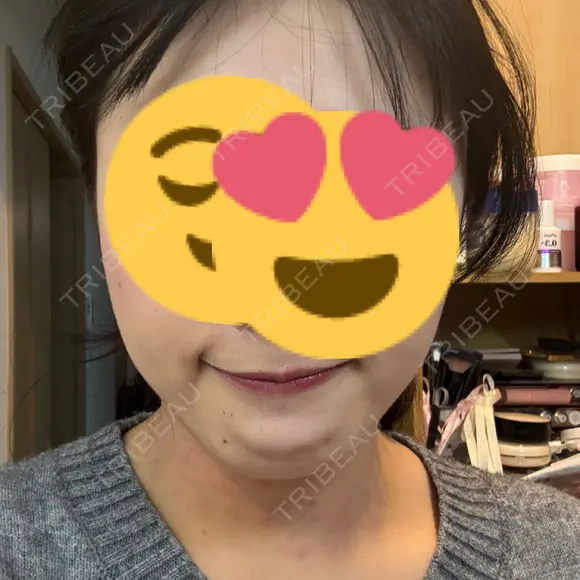 ボトックス（エラ・小顔） BISIN GINZA CLINIC DAY 1 メイン用
