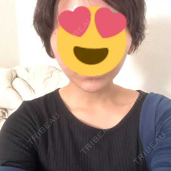 ハイフ（顔） A CLINIC（エークリニック） 仙台院 AFTER メイン用