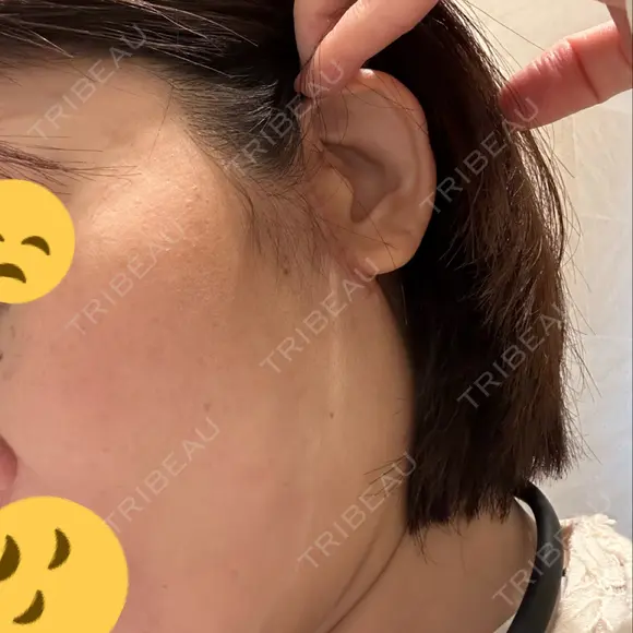 切開リフト GRACY TOKYO CLINIC【グレイシートウキョウクリニック】 DAY 36 メイン用