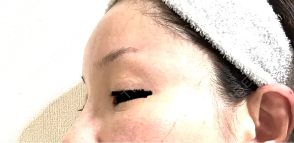 タレ目形成・グラマラスライン（埋没） Zetith Beauty Clinic 銀座院 DAY 4 メイン用