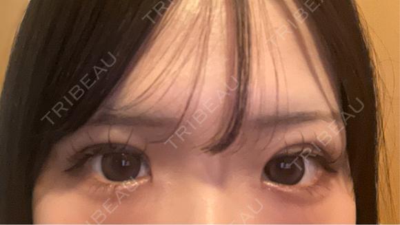 二重埋没 アリエル美容クリニック 郡山院 DAY 7 メイン用