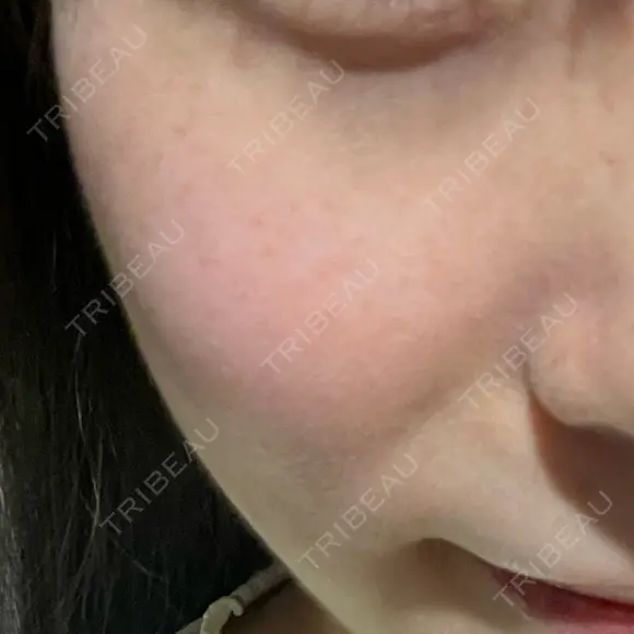 LDM・インテンスウルトラ Ledian Clinic六本木 DAY 3 メイン用