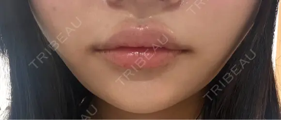 ヒアルロン酸注入（唇） Moon Beauty Clinic DAY 0 メイン用