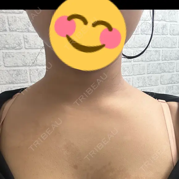 ボトックス（肩） DAILY SKIN CLINIC 福岡院 AFTER メイン用