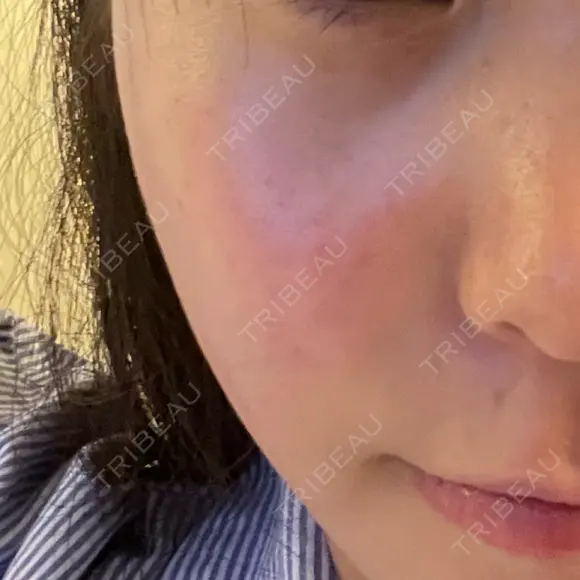 LDM・インテンスウルトラ Ledian Clinic六本木 DAY 4 メイン用