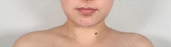 ボトックス（エラ・小顔） / ボトックス（肩） アリエル美容クリニック 水戸院 AFTER メイン用