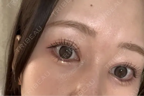 目頭切開 Brandnew Beauty Clinic AFTER メイン用