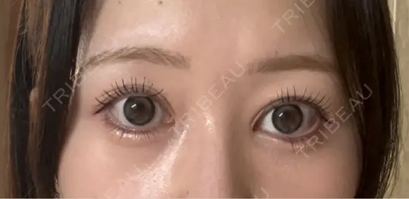 目頭切開 Brandnew Beauty Clinic DAY 523 メイン用