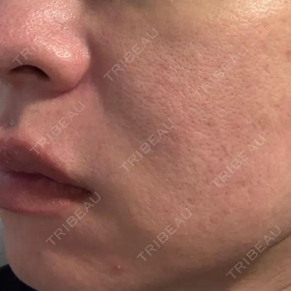 肌育注射（ジュベルックなど） / ニードルRF（ポテンツァなど） PureMe Skin Clinic（ピュアミースキンクリニック麻布） DAY 19 メイン用
