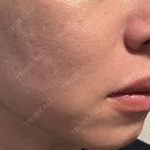 肌育注射（ジュベルックなど） / ニードルRF（ポテンツァなど） PureMe Skin Clinic（ピュアミースキンクリニック麻布） DAY 19 メイン用