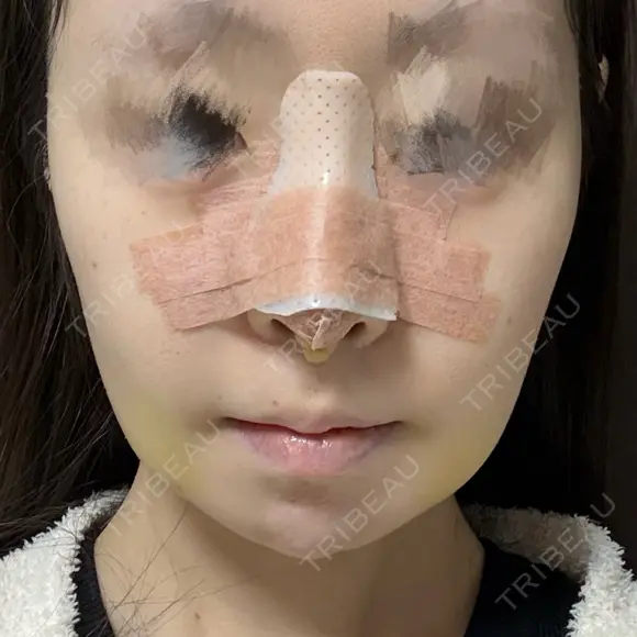 鼻尖形成（切開） / 鼻中隔延長（切開） / 軟骨移植 / 鼻尖縮小 / 鼻翼基部形成（貴族手術） ジョウクリニック 大阪院 DAY 3 メイン用